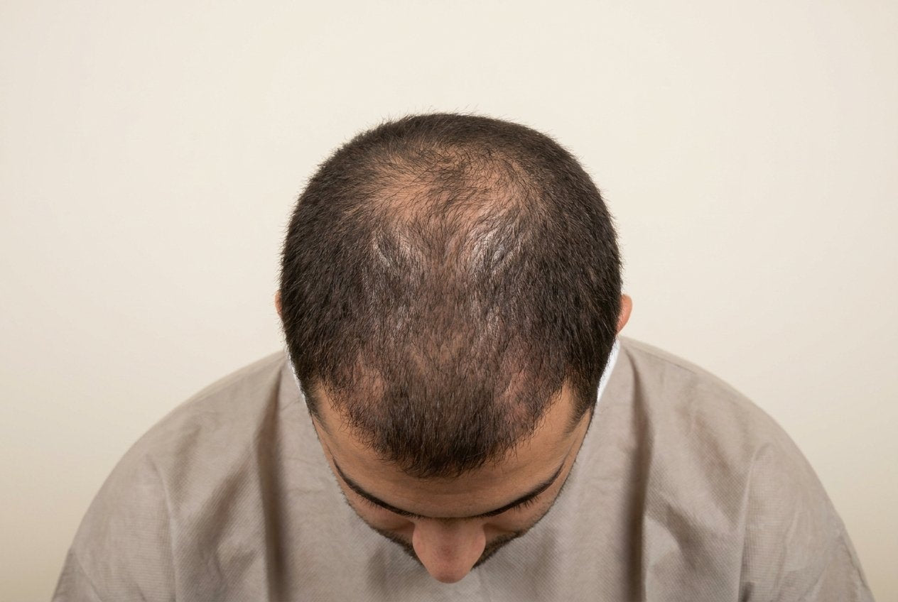 Crown density — before