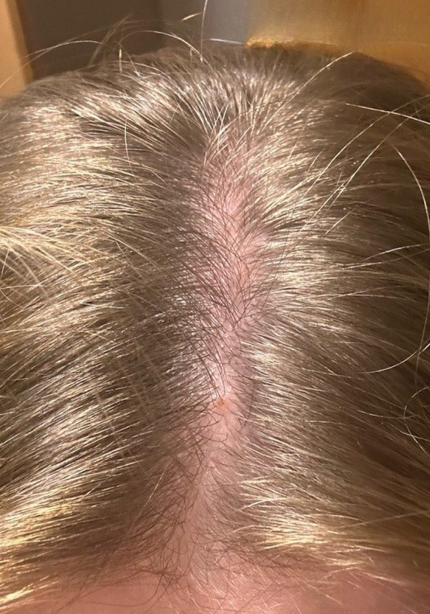Before using PinoPlex - hair density at parting