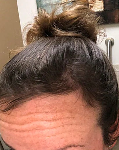 After using PinoPlex - fuller-looking hairline