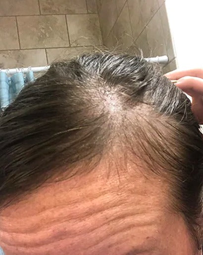 Before using PinoPlex - hairline density