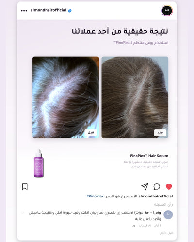 PinoPlex™ — real customer result, before and after