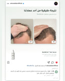 RootBioTec™ — real customer result, before and after
